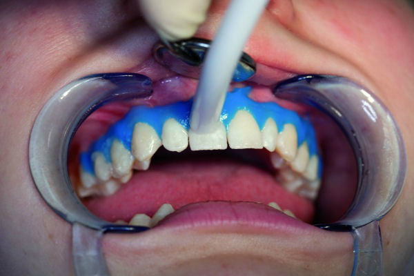 gum protection