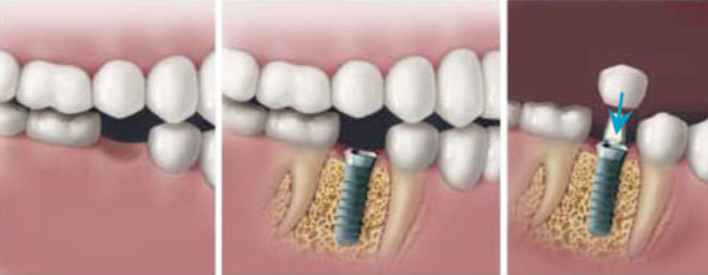 single implant