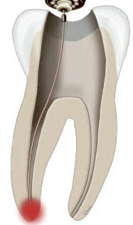 endo laser apex