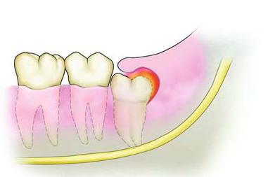 160314040948Pericoronitis