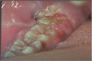 pericoronitis3